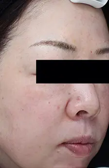 症例「根本的な肌質改善でシミ・くすみも綺麗に！」の施術後の写真