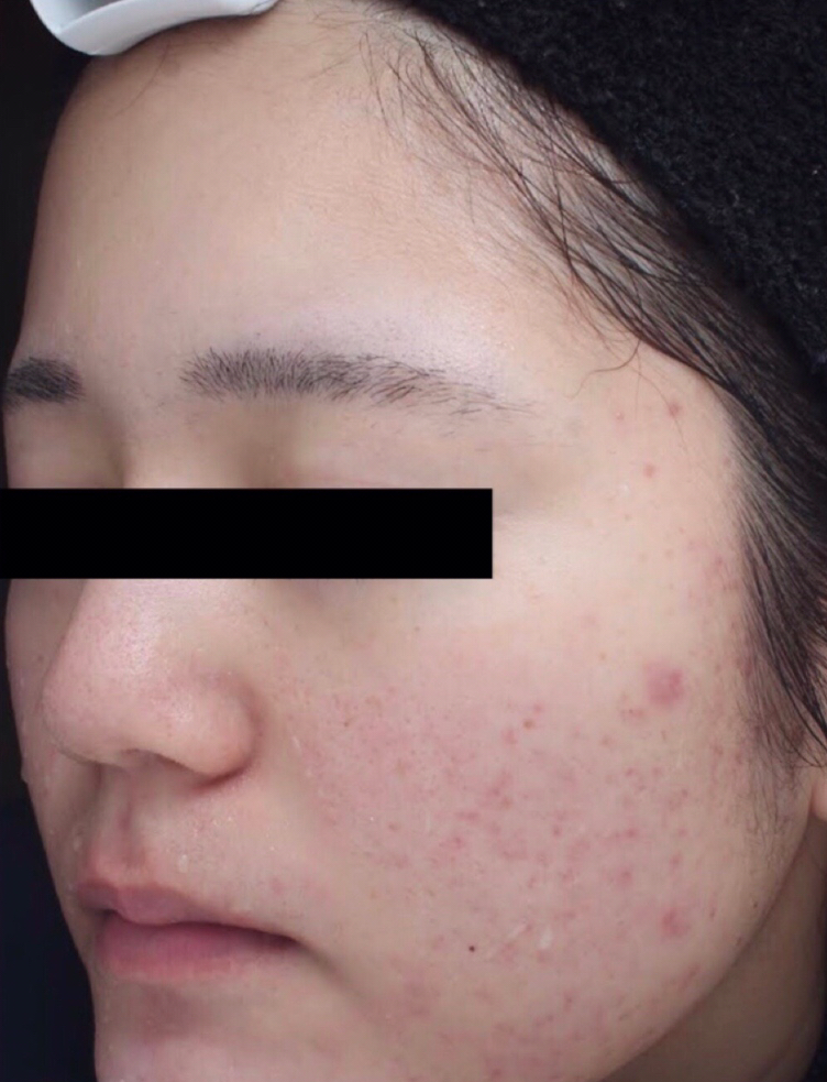 症例「赤み・ニキビが改善」の施術前の写真