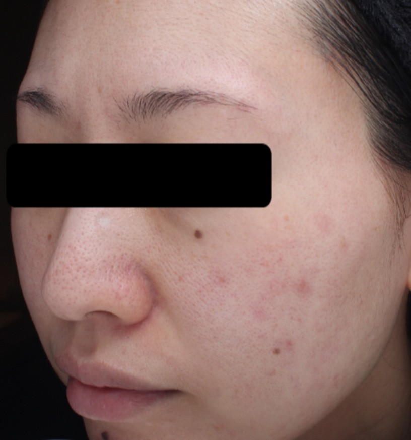 症例「メソナJピンク+ハイドラフェイシャル」の施術前の写真
