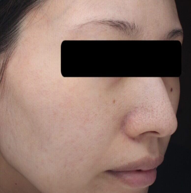症例「メソナJピンク+ハイドラフェイシャル」の施術後の写真
