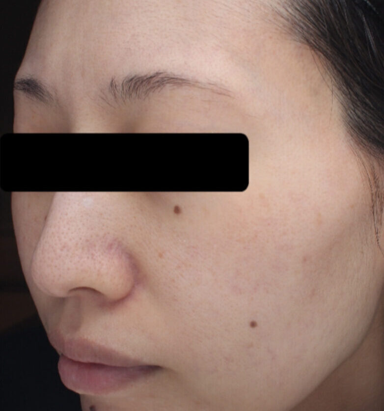 症例「メソナJピンク+ハイドラフェイシャル」の施術後の写真