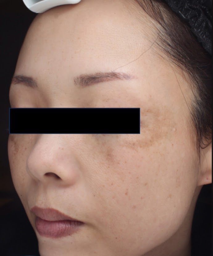 症例「肝斑が気になる方に」の施術前の写真