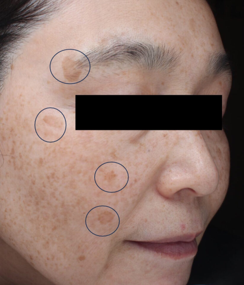 症例「メソナJイエロー（YAGレーザー・ピコレーザとの併用）」の施術前の写真