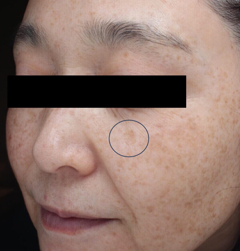 症例「メソナJイエローとピコレーザーの併用」の施術前の写真