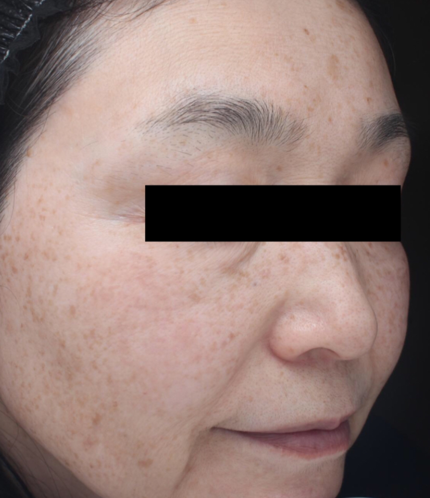 症例「メソナJイエロー（YAGレーザー・ピコレーザとの併用）」の施術後の写真