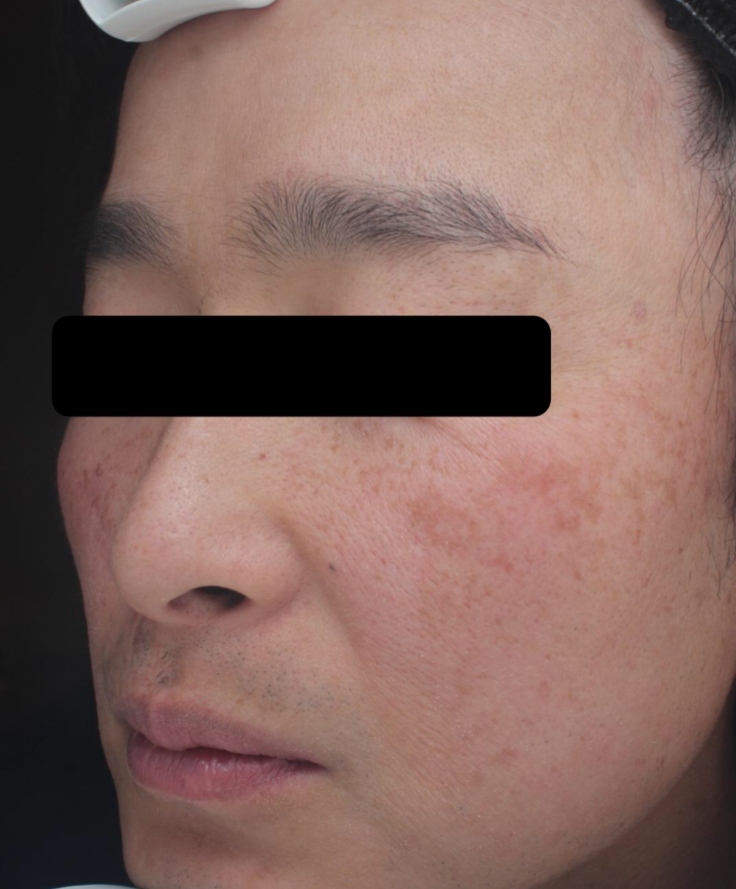 症例「メソナJイエロー」の施術前の写真