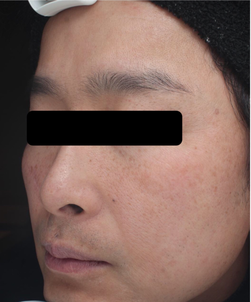 症例「メソナJイエロー」の施術後の写真