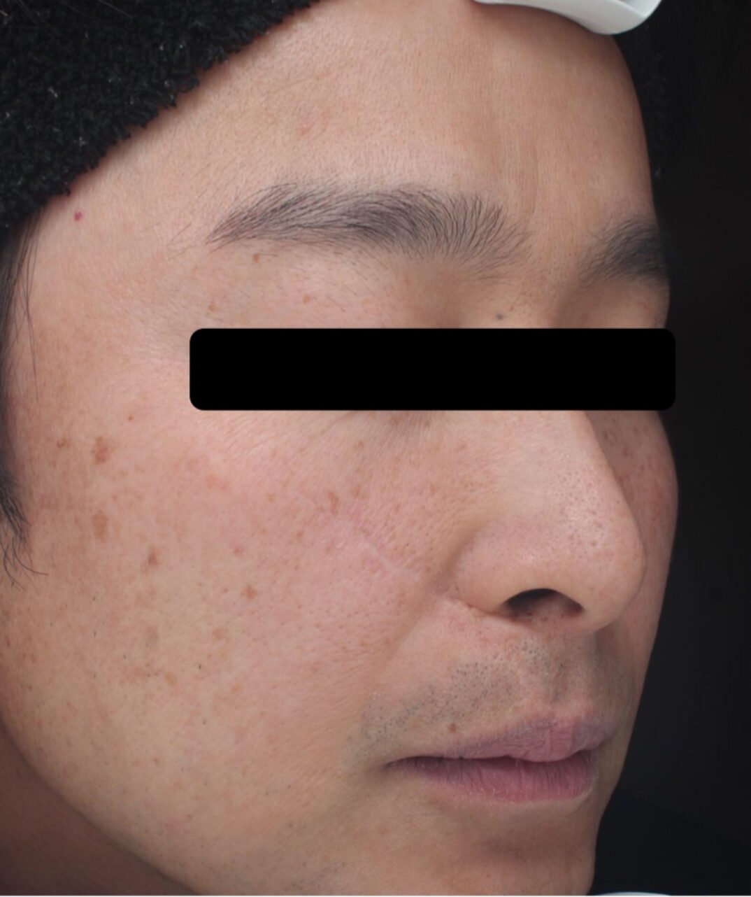 症例「メソナJイエロー」の施術後の写真