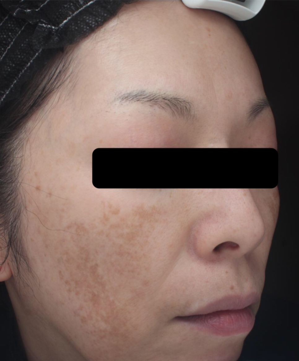 症例「メソナJイエロー」の施術前の写真