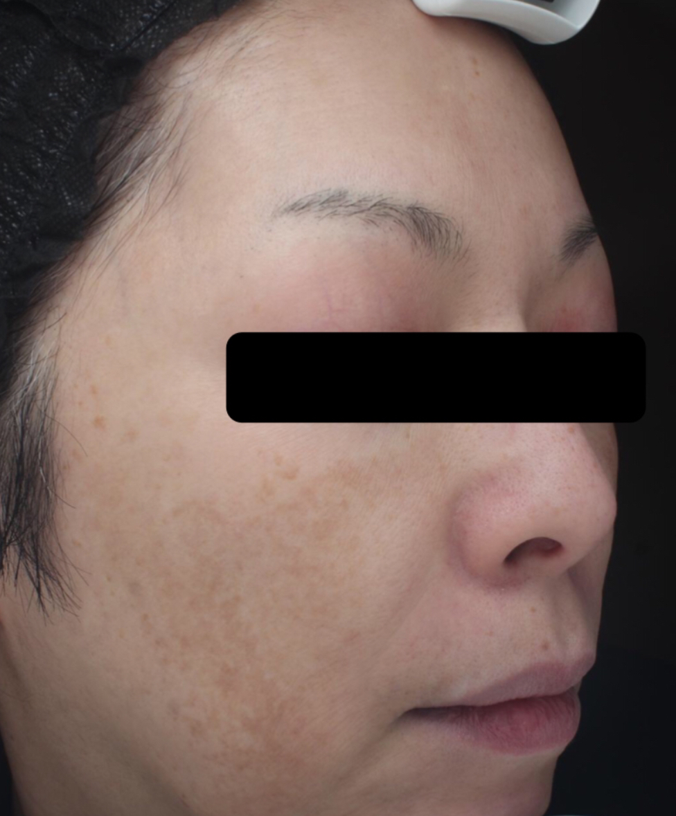 症例「メソナJイエロー」の施術後の写真