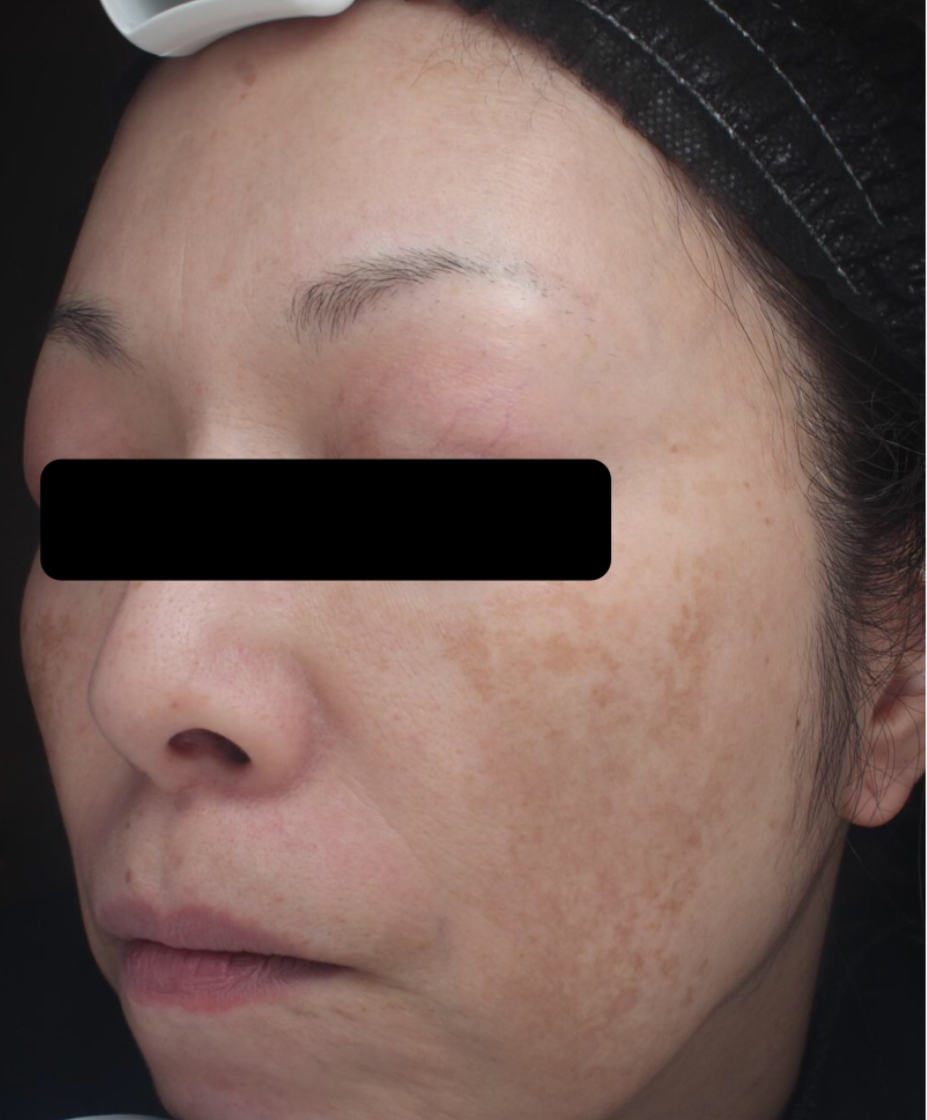 症例「メソナJイエロー」の施術前の写真