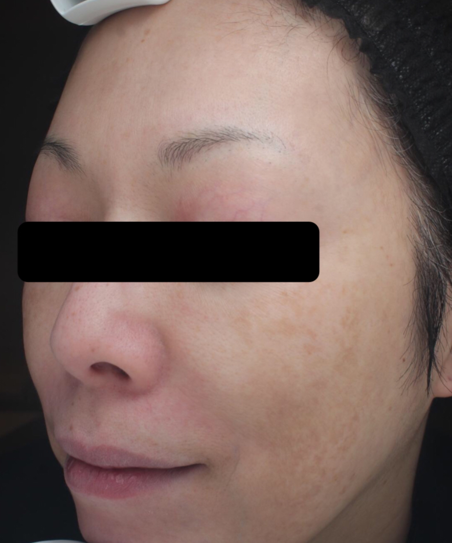 症例「メソナJイエロー」の施術後の写真